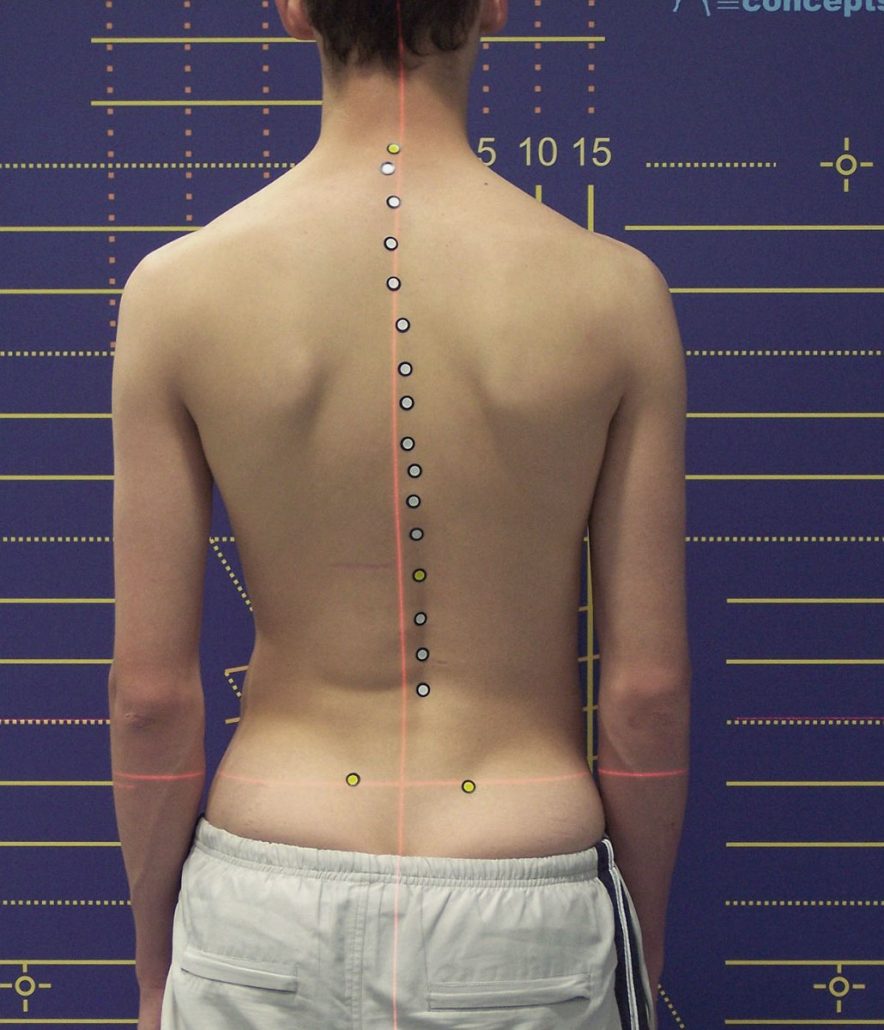 Scoliosis - Berlin & Munich